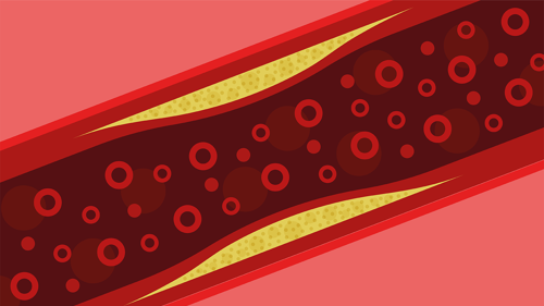 0525-101-AI-News-Micro-nano-plastics-found-in-artery-clogging-plaque-in-the-neck_Teaser.png